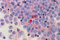 Acute myelocytic leukaemia